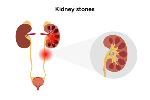 Uretric & Kidney Stone Removal