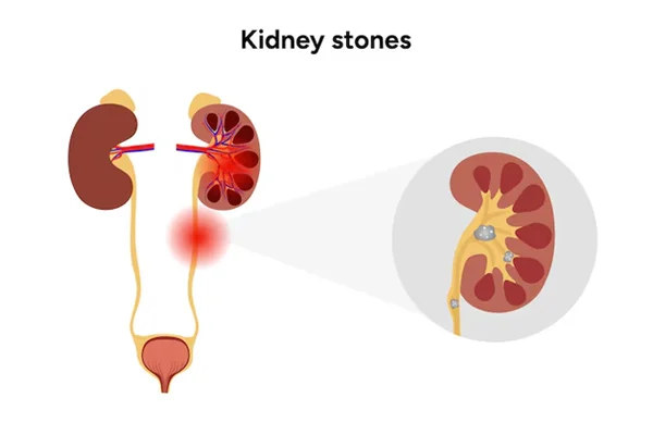 Uretric and Kidney Stone Removal