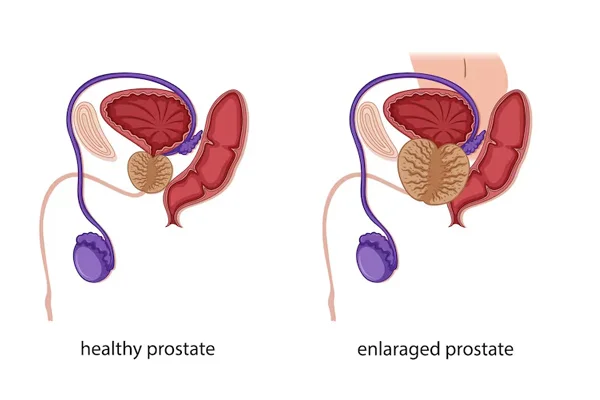 Prostate Procedures